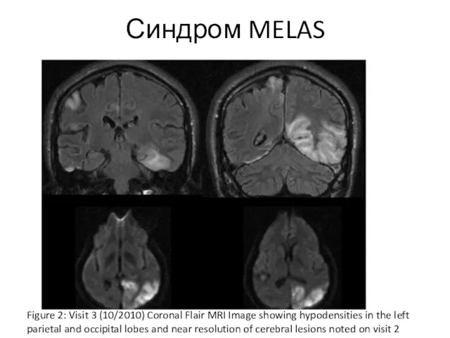 Синдром MELAS Figure 2: Visit 3 (10/2010) Coronal Flair MRI Image showing