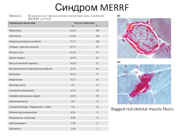 Синдром MERRF Ragged-red skeletal muscle fibers.