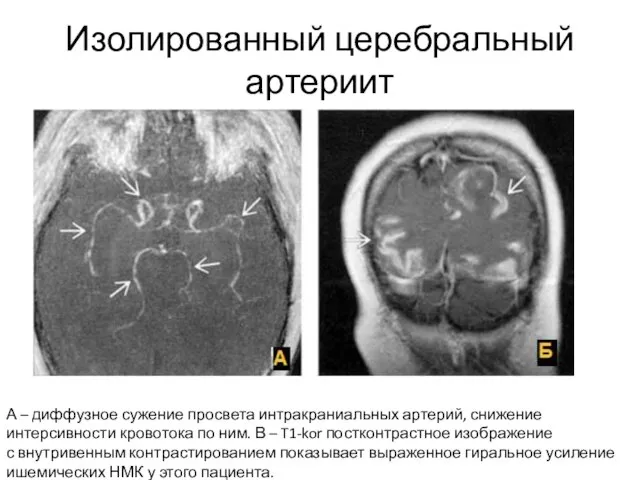 Изолированный церебральный артериит А – диффузное сужение просвета интракраниальных артерий, снижение интерсивности