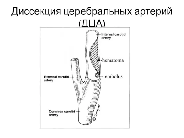 Диссекция церебральных артерий (ДЦА)