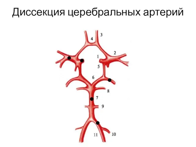 Диссекция церебральных артерий