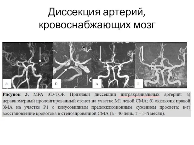 Диссекция артерий, кровоснабжающих мозг