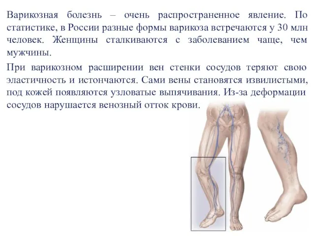 Варикозная болезнь – очень распространенное явление. По статистике, в России разные формы