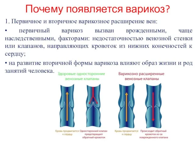 Почему появляется варикоз? 1. Первичное и вторичное варикозное расширение вен: • первичный