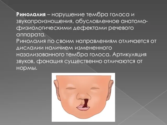 Ринолалия – нарушение тембра голоса и звукопроизношения, обусловленное анатомо-физиологическими дефектами речевого аппарата.