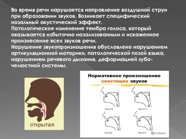 Во время речи нарушается направление воздушной струи при образовании звуков. Возникает специфический