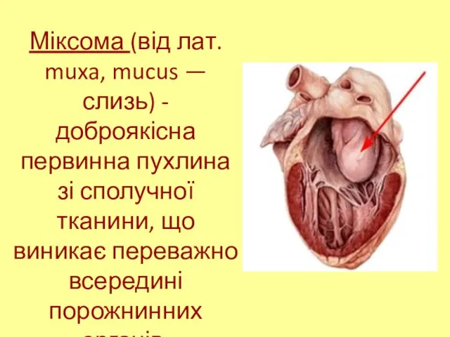 Міксома (від лат. muxa, mucus — слизь) - доброякісна первинна пухлина зі