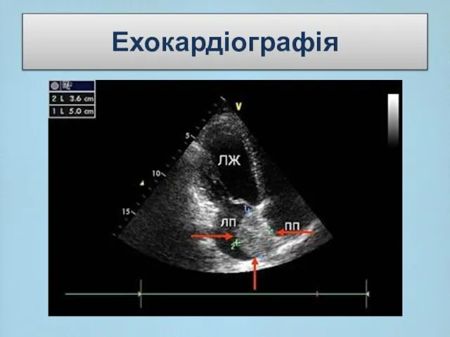 Ехокардіографія