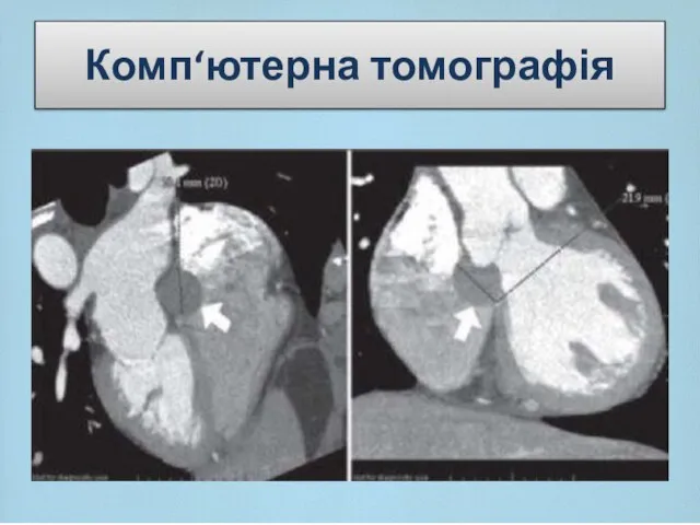 Комп‘ютерна томографія