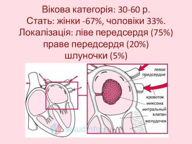 Вікова категорія: 30-60 р. Стать: жінки -67%, чоловіки 33%. Локалізація: ліве передсердя