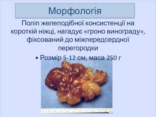 Поліп желеподібної консистенції на короткій ніжці, нагадує «гроно винограду», фіксований до міжпередсердної