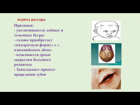 период разгара. Признаки: - увеличиваются лобные и теменные бугры - голова приобретает