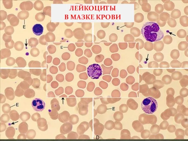 ЛЕЙКОЦИТЫ В МАЗКЕ КРОВИ