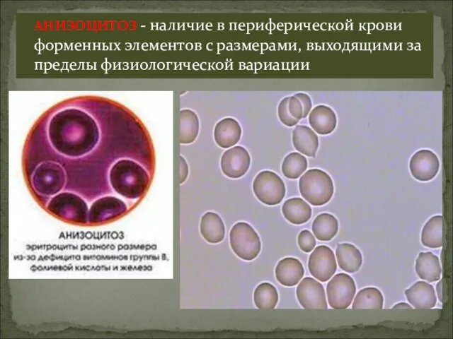 АНИЗОЦИТОЗ - наличие в периферической крови форменных элементов с размерами, выходящими за пределы физиологической вариации