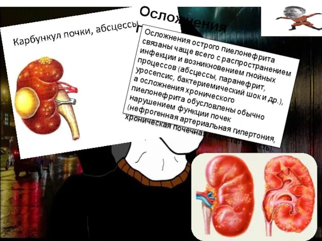 Осложнения пиелонефрита Осложнения острого пиелонефрита связаны чаще всего с распространением инфекции и