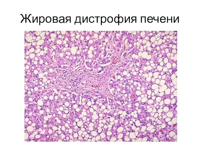 Жировая дистрофия печени