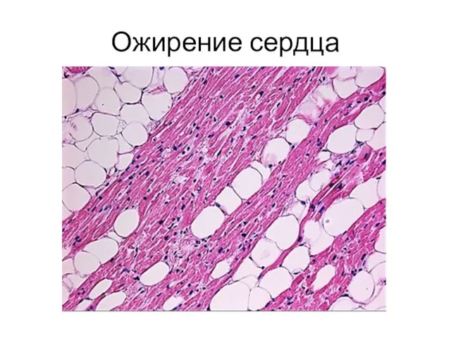 Ожирение сердца