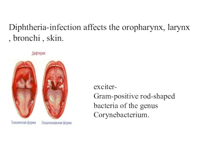 Diphtheria-infection affects the oropharynx, larynx , bronchi , skin. exciter- Gram-positive rod-shaped