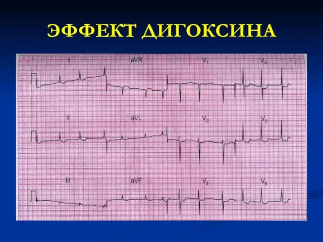 ЭФФЕКТ ДИГОКСИНА