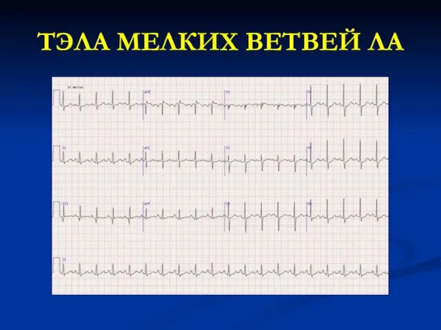 ТЭЛА МЕЛКИХ ВЕТВЕЙ ЛА