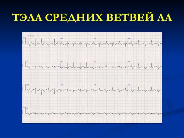 ТЭЛА СРЕДНИХ ВЕТВЕЙ ЛА