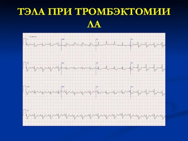 ТЭЛА ПРИ ТРОМБЭКТОМИИ ЛА