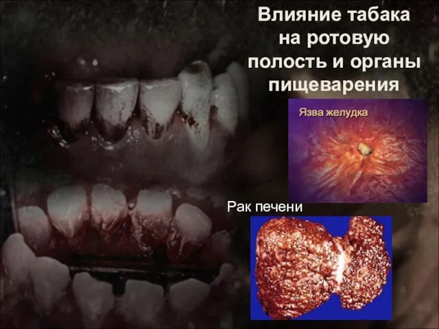 Влияние табака на ротовую полость и органы пищеварения Рак печени