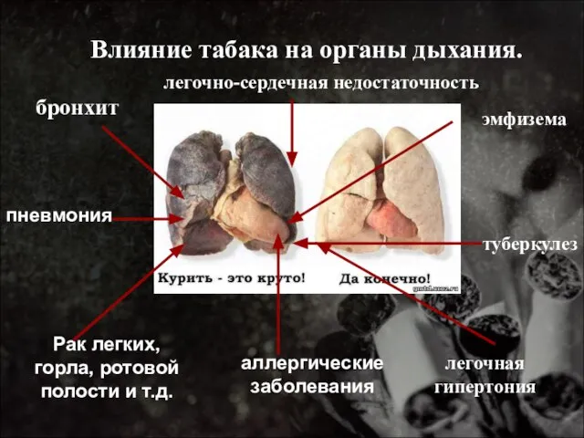 Влияние табака на органы дыхания. бронхит пневмония Рак легких, горла, ротовой полости