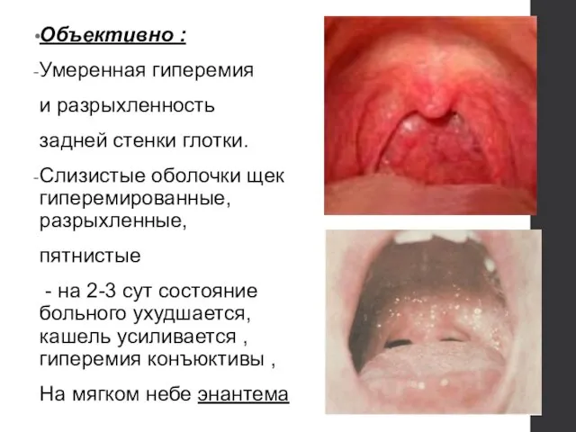 Объективно : Умеренная гиперемия и разрыхленность задней стенки глотки. Слизистые оболочки щек