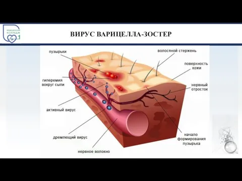 ВИРУС ВАРИЦЕЛЛА-ЗОСТЕР