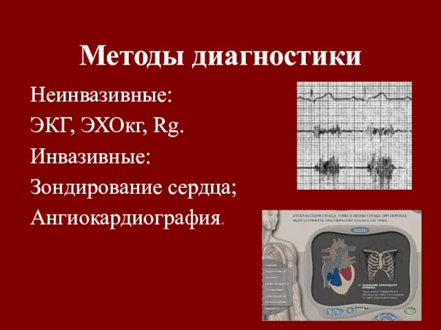 Методы диагностики Неинвазивные: ЭКГ, ЭХОкг, Rg. Инвазивные: Зондирование сердца; Ангиокардиография.
