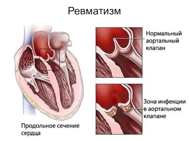 Ревматизм