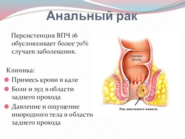 Анальный рак Персистенция ВПЧ 16 обусловливает более 70% случаев заболевания. Клиника: Примесь