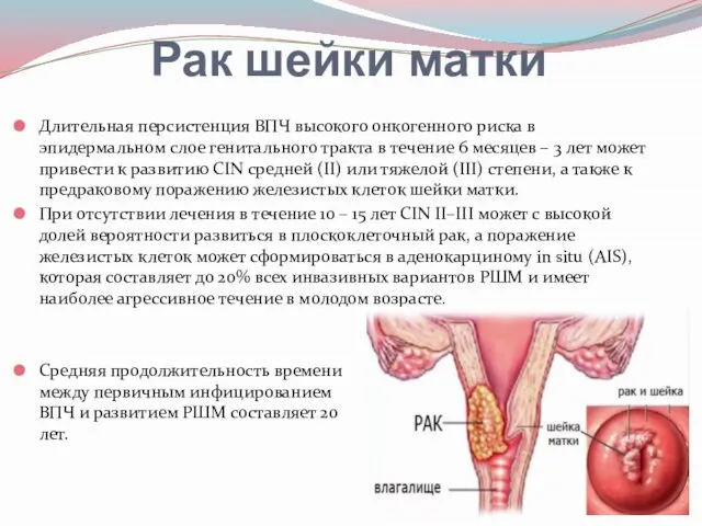 Рак шейки матки Длительная персистенция ВПЧ высокого онкогенного риска в эпидермальном слое