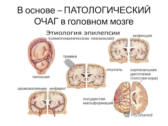 В основе – ПАТОЛОГИЧЕСКИЙ ОЧАГ в головном мозге