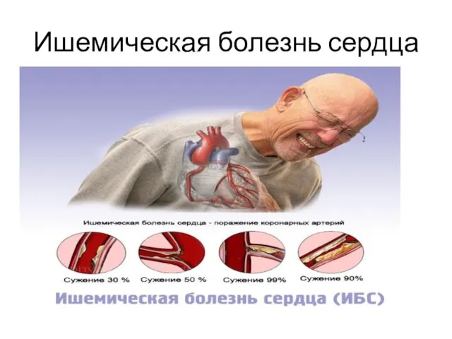 Ишемическая болезнь сердца