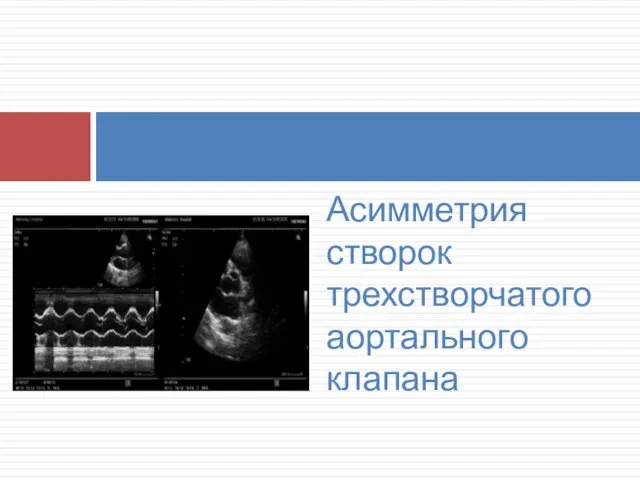 Асимметрия створок трехстворчатого аортального клапана