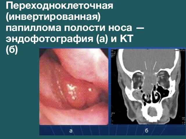 Переходноклеточная (инвертированная) папиллома полости носа — эндофотография (а) и КТ (б)