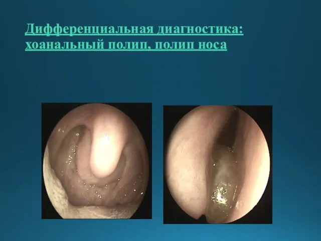 Дифференциальная диагностика: хоанальный полип, полип носа