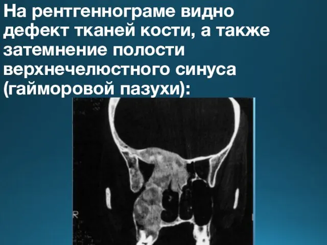 На рентгеннограме видно дефект тканей кости, а также затемнение полости верхнечелюстного синуса (гайморовой пазухи):