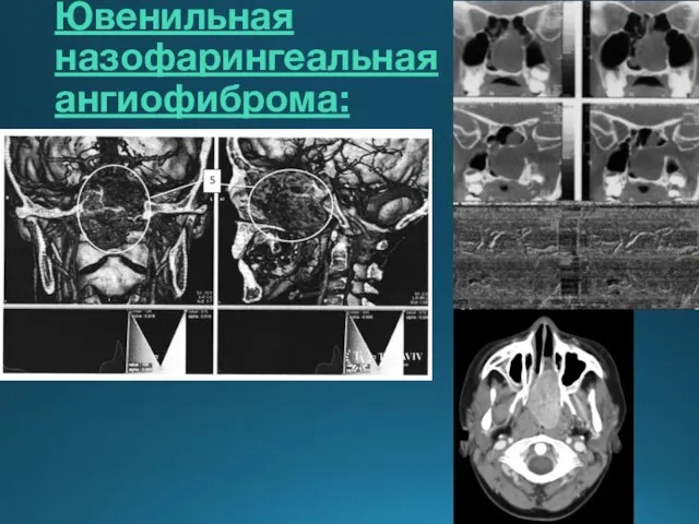 Ювенильная назофарингеальная ангиофиброма: