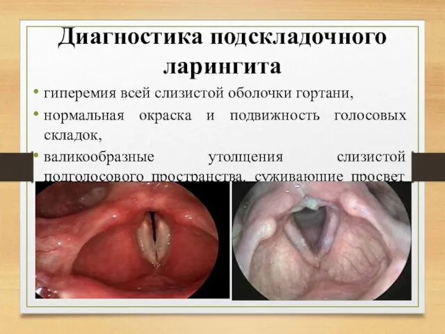 Диагностика подскладочного ларингита гиперемия всей слизистой оболочки гортани, нормальная окраска и подвижность