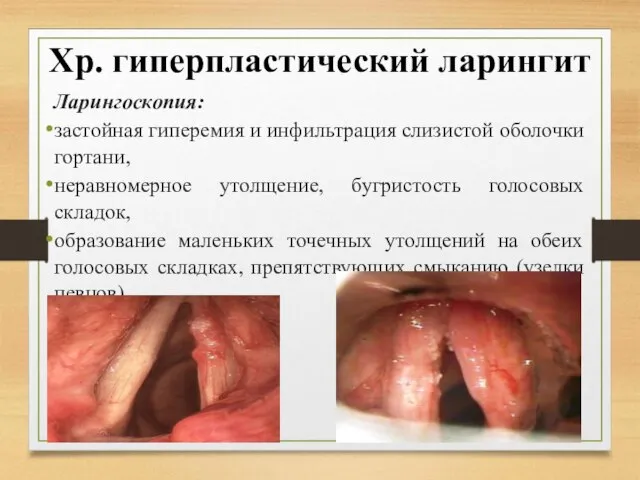 Хр. гиперпластический ларингит Ларингоскопия: застойная гиперемия и инфильтрация слизистой оболочки гортани, неравномерное