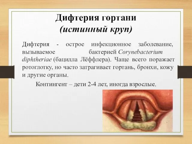 Дифтерия гортани (истинный круп) Дифтерия - острое инфекционное заболевание, вызываемое бактерией Corynebacterium