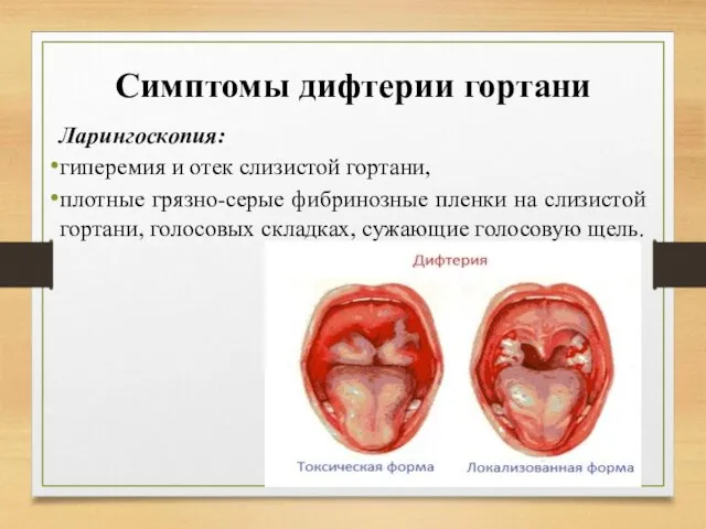 Симптомы дифтерии гортани Ларингоскопия: гиперемия и отек слизистой гортани, плотные грязно-серые фибринозные