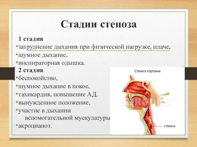 Стадии стеноза 1 стадия затруднение дыхания при физической нагрузке, плаче, шумное дыхание,