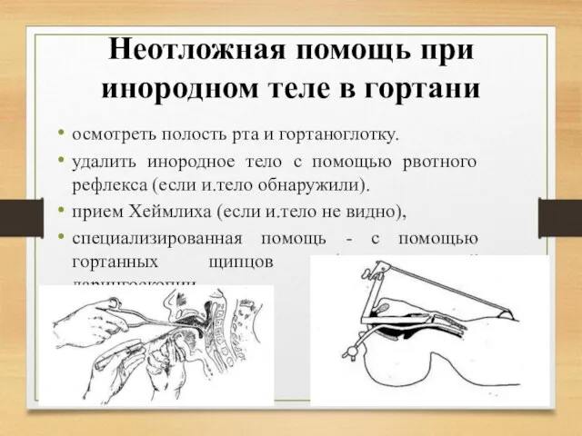 Неотложная помощь при инородном теле в гортани осмотреть полость рта и гортаноглотку.