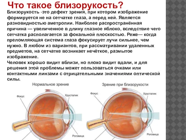 Близорукость -это дефект зрения, при котором изображение формируется не на сетчатке глаза,