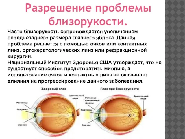 Часто близорукость сопровождается увеличением переднезаднего размера глазного яблока. Данная проблема решается с