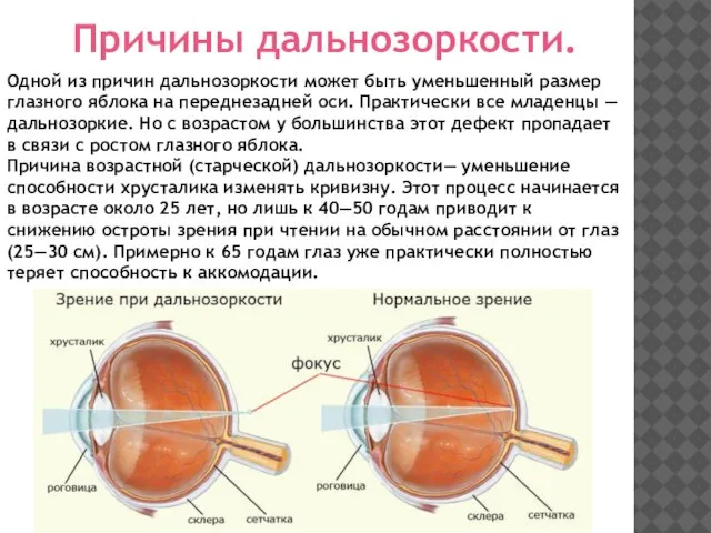 Одной из причин дальнозоркости может быть уменьшенный размер глазного яблока на переднезадней